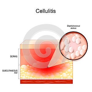 Cellulitis. layers of the human Skin. Close-up of Staphylococcus aureus