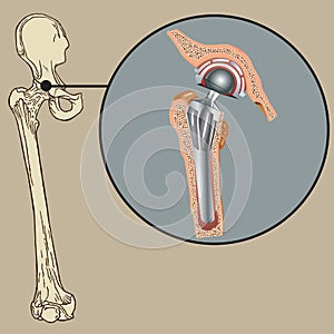 Cementless Arthroplasty Prosthesis vector illustration