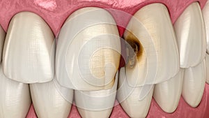 Central incisor teeth damaged by caries. Medically accurate tooth animation