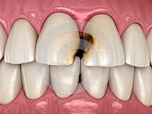 Central incisor teeth damaged by caries. Medically accurate tooth illustration