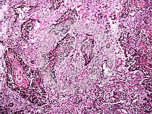 Central lung cancer of a human