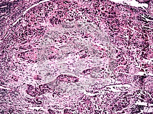 Central lung cancer of a human photo