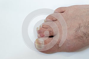 Central polydactyly on human foot toe  on white background