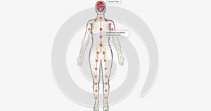 Central sensitization, also called central pain, is a condition associated with the development of chronic pain photo