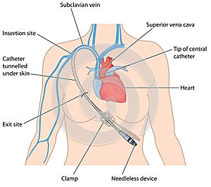 Central venous catheter in subclavian vein photo