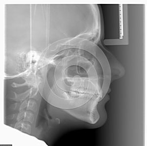 Cephalometric X-ray used in dentistry and orthodontics