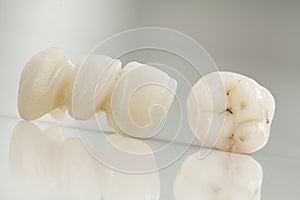 Ceramic bridge close up view