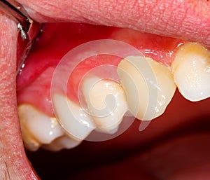 Ceramic crown on tooth