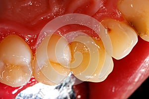 Ceramic crown on tooth