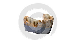 Ceramic crown of a tooth on a plaster model of the teeth, the work of a dental technician, tools for dental prosthetics.Isolated