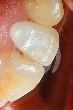 Ceramic crown with zirconia base