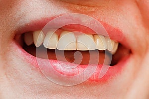 Ceramic crown with zirconia base