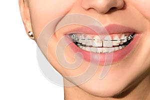 Ceramic Dental Braces Teeth Female Smile