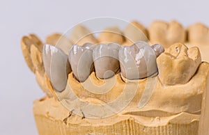 Ceramic dental implants