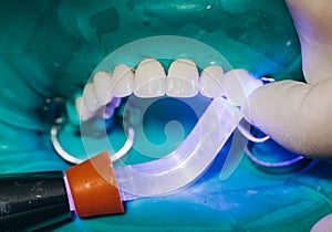 Ceramic front crowns, green background. 8 units dental veneers photo