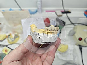 Ceramic-metal bridge prosthesis is demonstrated by a doctor in a dental laboratory