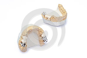 Ceramic-metal bridges on the models of the upper and lower jaws. prosthetics of damaged and missing teeth