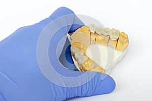 Ceramic-metal bridges. non-permanent dental prosthetics. orthopedic dentistry. false teeth