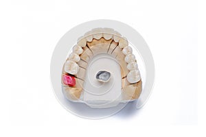 ceramic-metal crowns. ceramic-metal bridge. artificial tooth. White teeth. orthopedic dentistry. dental prosthetics