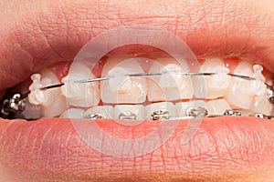 Ceramic and metal orthodontic cases on teeth photo