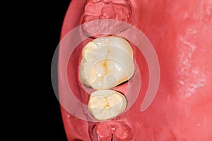 Ceramic molar onlay