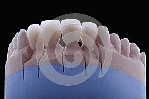 Ceramic teeth