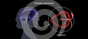 Ataxia cerebellar disorder photo