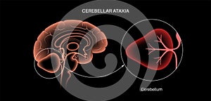 Ataxia cerebellar disorder photo