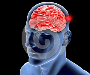 Cerebral aneurysm, brain head photo