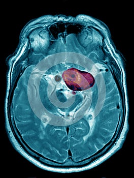 Cerebral aneurysm, illustration, MRI