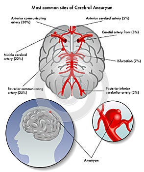 Cerebral aneurysm photo