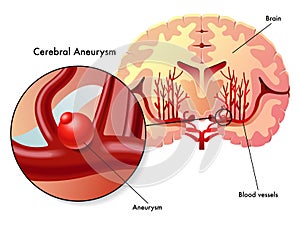 Cerebral aneurysm photo