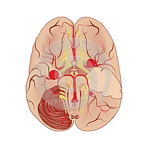 Cerebral aneurysms, ventral view.