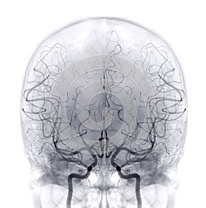 Cerebral angiography  image from Fluoroscopy in intervention radiology  showing cerebral artery