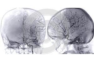 Cerebral angiography  image from Fluoroscopy in intervention radiology  showing cerebral artery