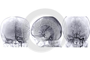 Cerebral angiography  image from Fluoroscopy in intervention radiology  showing cerebral artery