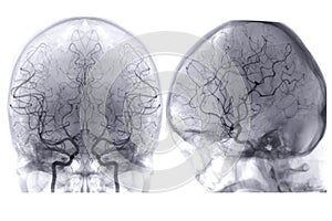 Cerebral angiography  image from Fluoroscopy in intervention radiology  showing cerebral artery