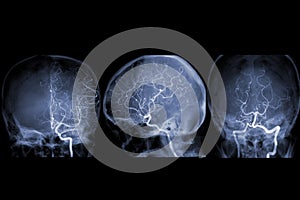 Cerebral angiography  image from Fluoroscopy in intervention radiology  showing cerebral artery