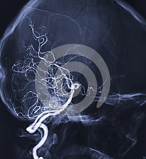 Cerebral angiography  image from Fluoroscopy in intervention radiology  showing cerebral artery