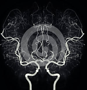 Cerebral angiography  image from Fluoroscopy in intervention radiology  showing cerebral artery