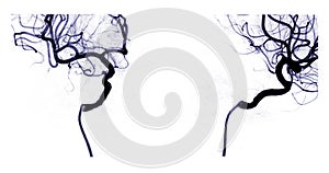 Cerebral angiography  image from Fluoroscopy in intervention radiology  showing cerebral artery