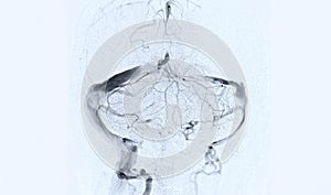 Cerebral angiography  image from Fluoroscopy in intervention radiology  showing cerebral artery