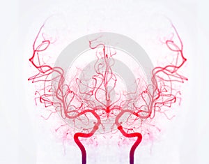 Cerebral angiography  image from Fluoroscopy in intervention radiology  showing cerebral artery