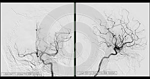 Cerebral angiography  image from Fluoroscopy in intervention radiology  showing cerebral artery