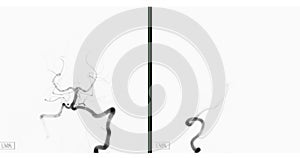 Cerebral angiography  image from Fluoroscopy in intervention radiology  showing cerebral artery