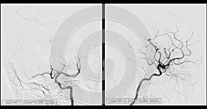 Cerebral angiography  image from Fluoroscopy in intervention radiology  showing cerebral artery