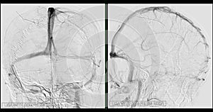 Cerebral angiography  image from Fluoroscopy in intervention radiology  showing cerebral artery
