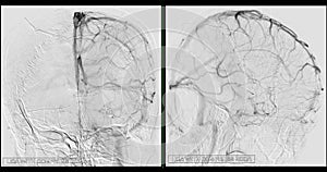 Cerebral angiography  image from Fluoroscopy in intervention radiology  showing cerebral artery