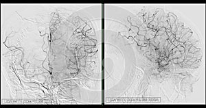 Cerebral angiography  image from Fluoroscopy in intervention radiology  showing cerebral artery