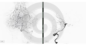 Cerebral angiography  image from Fluoroscopy in intervention radiology  showing cerebral artery